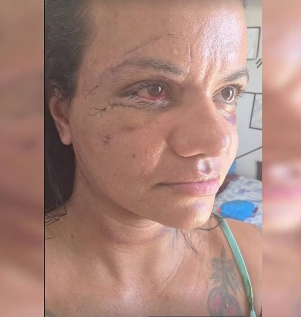 Dias após cirurgia, mulher agredida com 61 socos mostra rosto