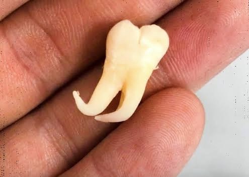 Dentes do siso contêm células-tronco que podem reparar seu coração cérebro e ossoS.