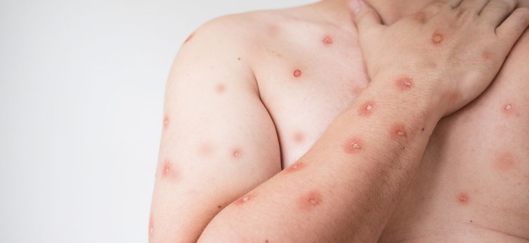 NOVA CEPA DO VÍRUS DA MPOX RECOMBINANTE PREOCUPA OMS E TESTES MOSTRAM QUE ANTIVIRAL MAIS USADO NÃO É EFICAZ.