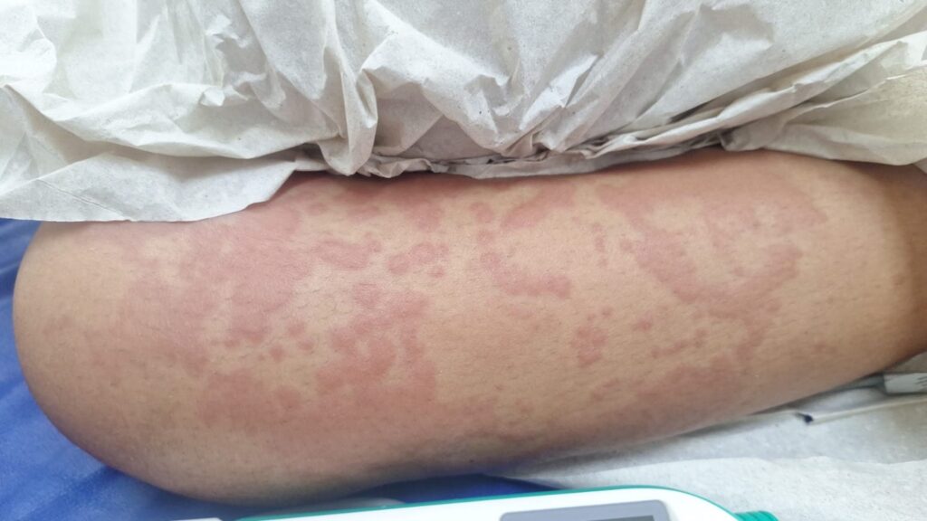 Criança é internada com infecção após contato com detergente suspenso pela Anvisa, diz mãe