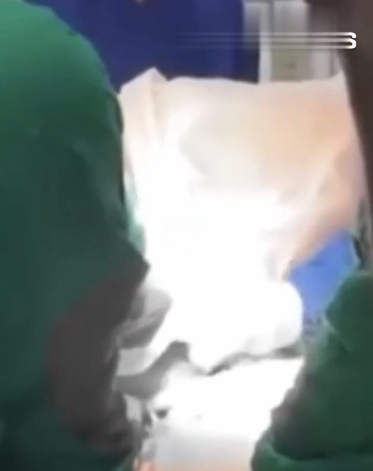PEDRA DE 3,1 KG E RETIRADA DA BEXIGA DE HOMEM NO SRI LANKA